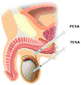 Surgical Sperm Retrieval Diagram